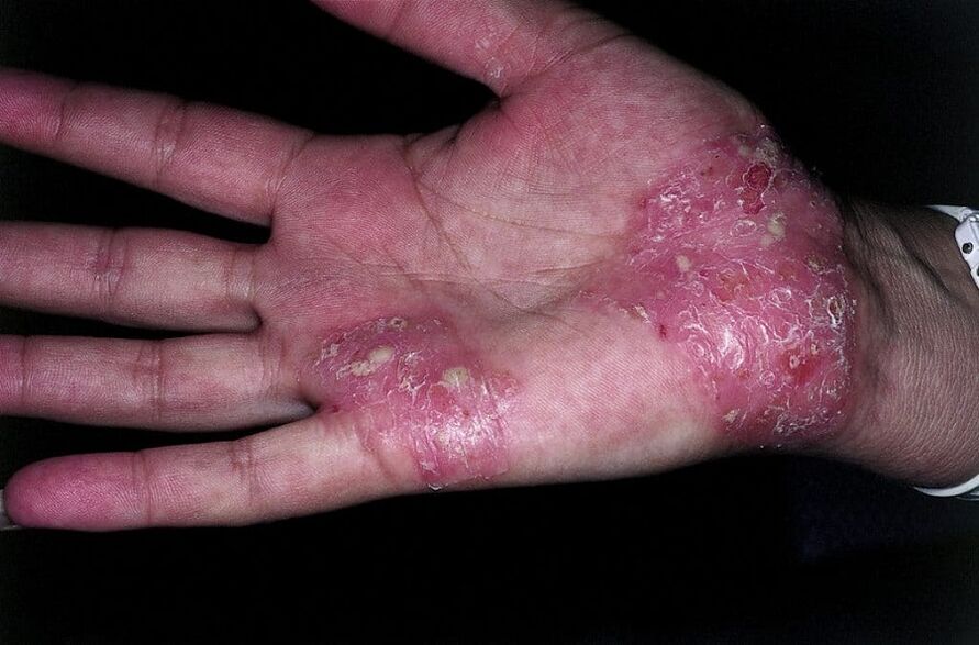 exacerbation du psoriasis sur les mains