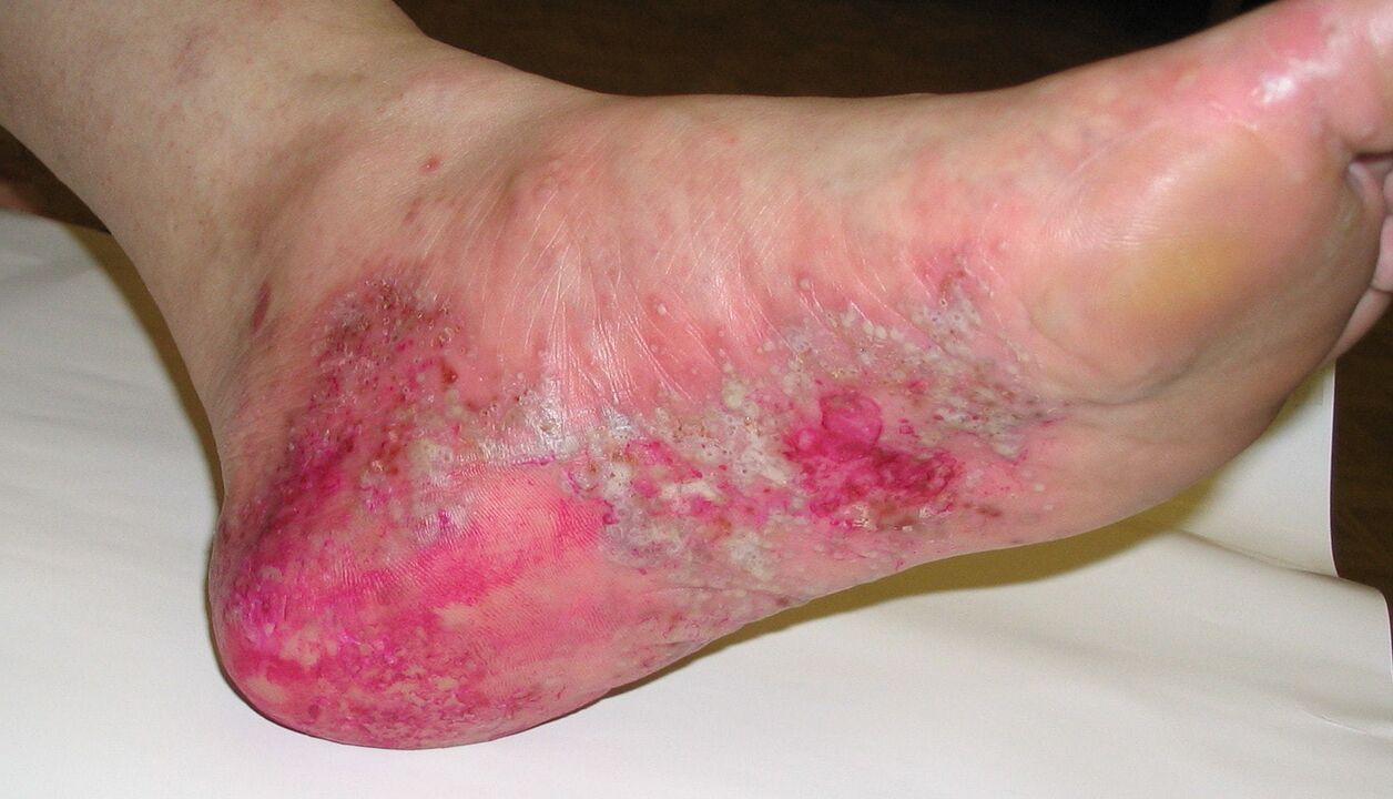 psoriasis sur le pied