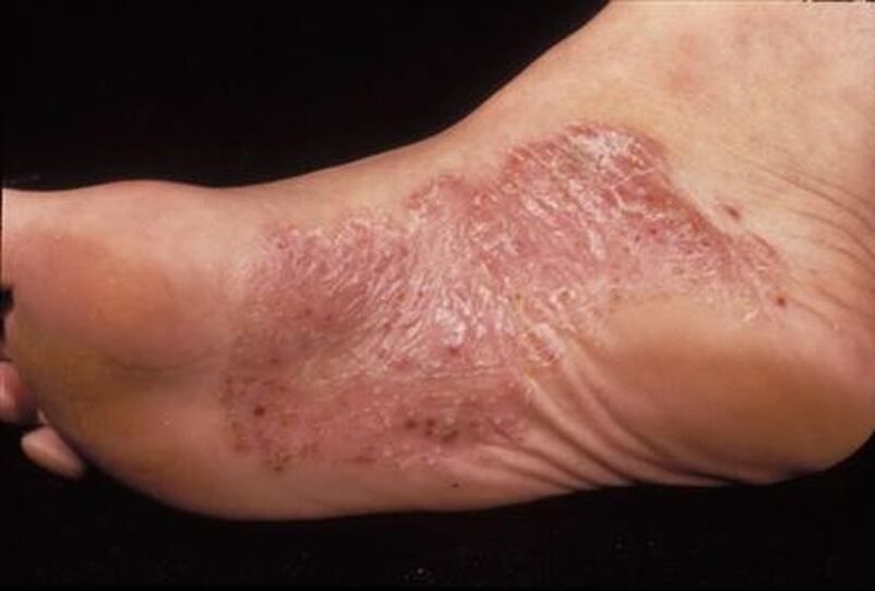 symptômes du psoriasis sur le pied