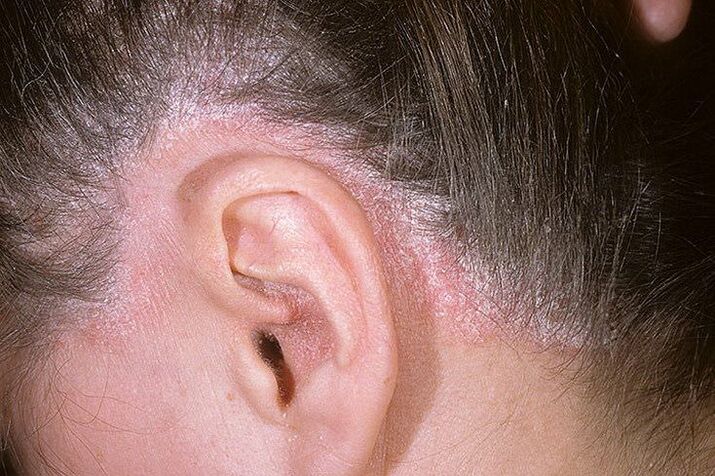 Éruptions de psoriasis sur la tête derrière les oreilles