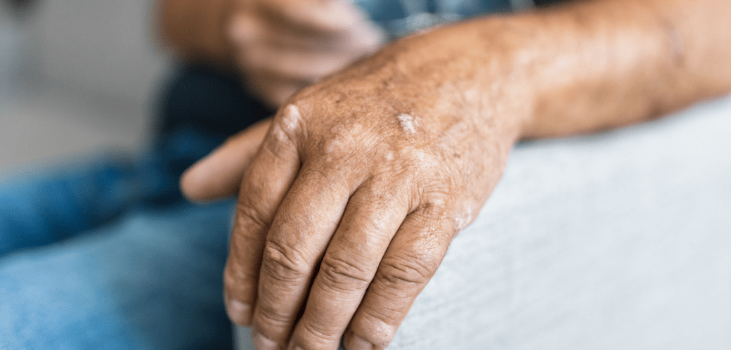 Psoriasis sur la peau de la main