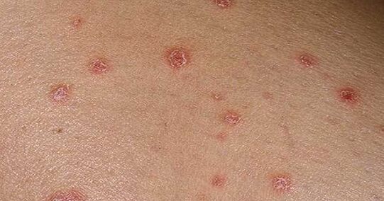 Plaques psoriatiques