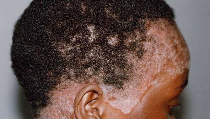 Psoriasis sur la tête