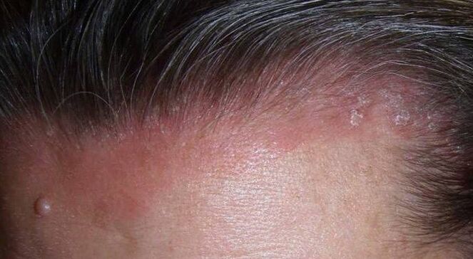 Qu'est-ce que le psoriasis