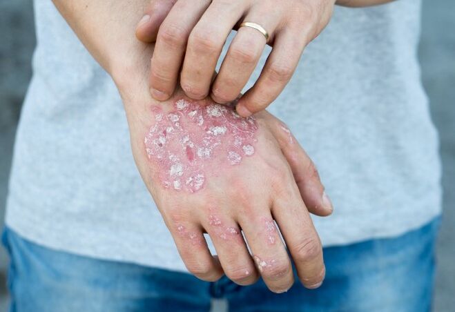 Psoriasis en mesnicherie