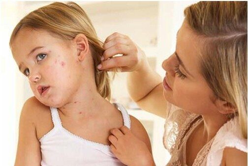 Psoriasis chez les enfants
