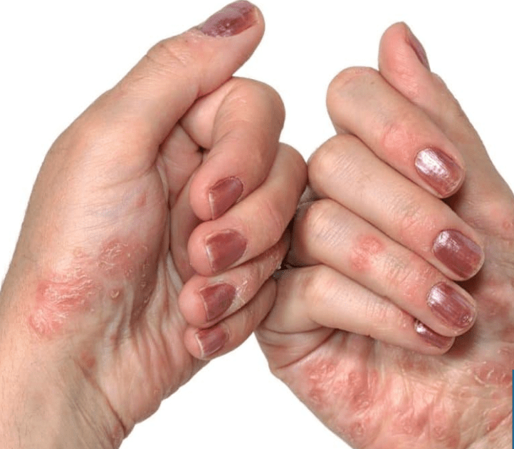 Psoriasis entre les mains