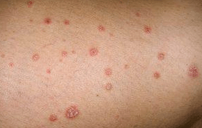 Plaques psoriatiques