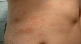 Psoriasis malchanceux