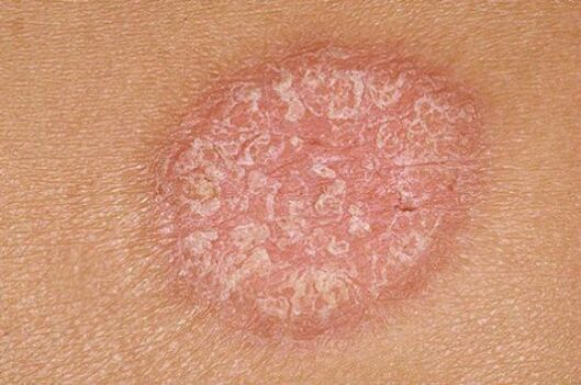 psoriasis
