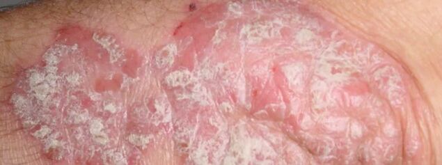 Psoriasis en mesnicherie