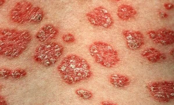 Formes de psoriasis