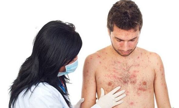 Photo de psoriasis
