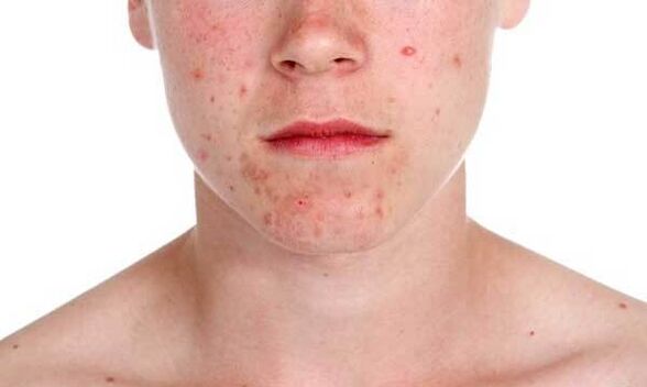 Symptômes du psoriasis