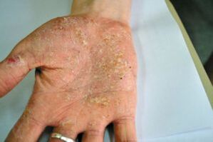 Psoriasis dans la paume de votre main