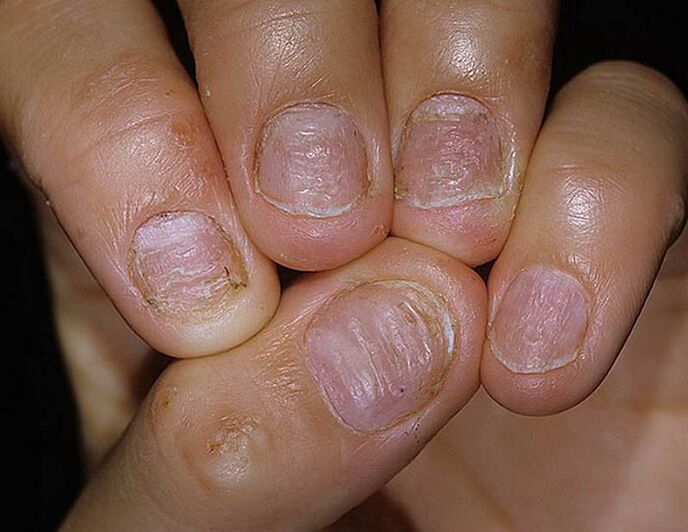 Psoriasis des ongles