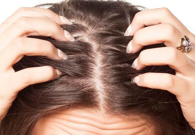 Psoriasis sur la tête
