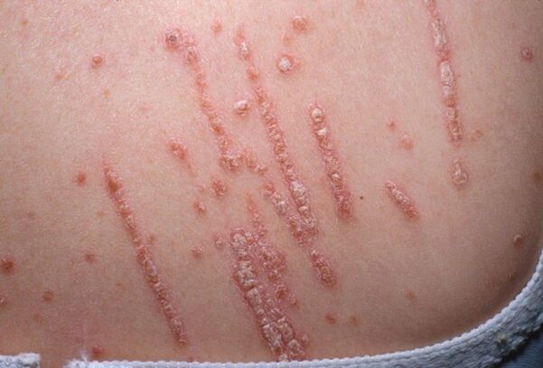 Psoriasis sur le corps