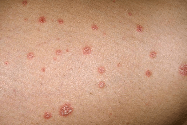 Plaques psoriasiques