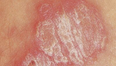 psoriasis