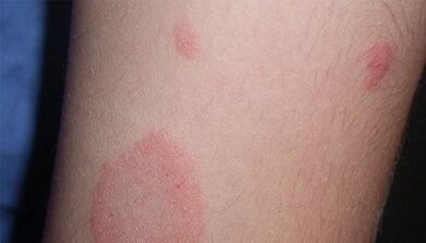 Comment se manifeste le stade initial du psoriasis