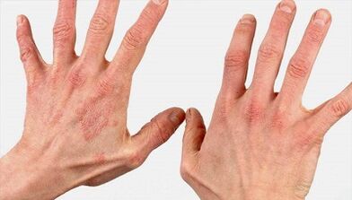 à quoi ressemble le stade initial du psoriasis