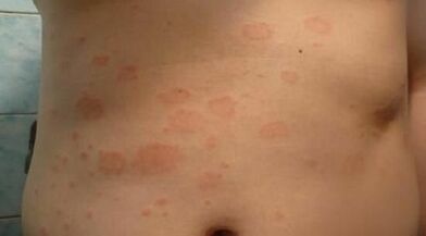 comment reconnaître le stade initial du psoriasis