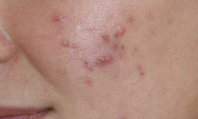 symptômes du stade initial du psoriasis