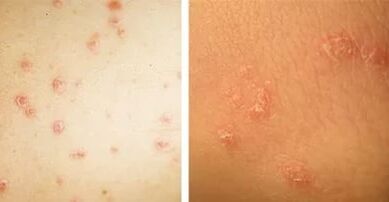 principales manifestations du psoriasis
