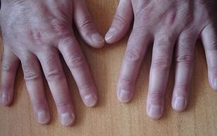 symptômes du psoriasis au stade initial