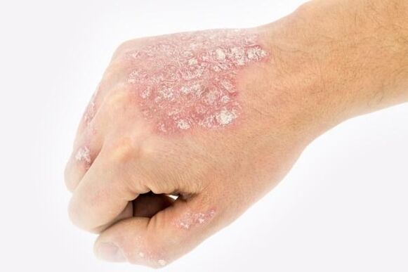 mécanisme de développement du psoriasis sur les mains