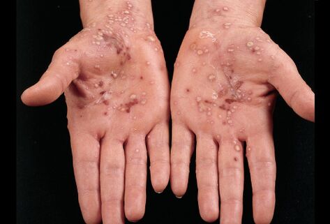 à quoi ressemble le psoriasis sur la paume des mains