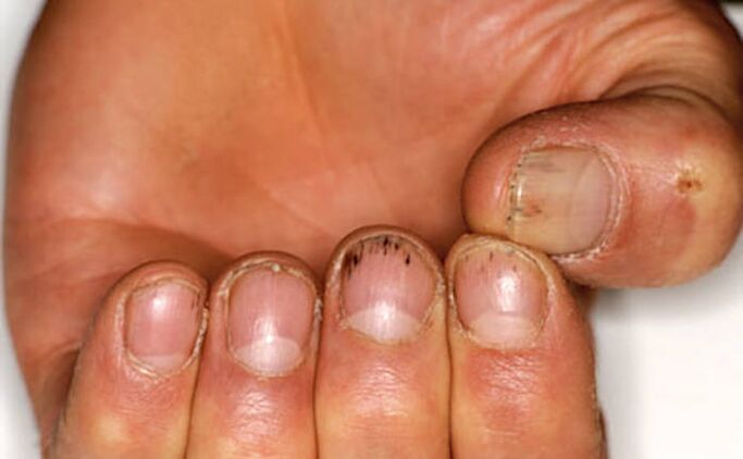Hémorragie sous les ongles avec psoriasis