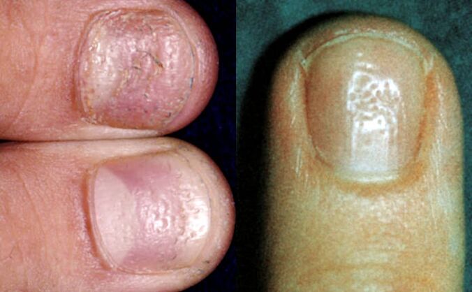 Symptôme du dé à coudre - plusieurs dépressions à la surface de la plaque à ongles