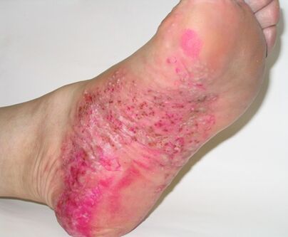 psoriasis au pied